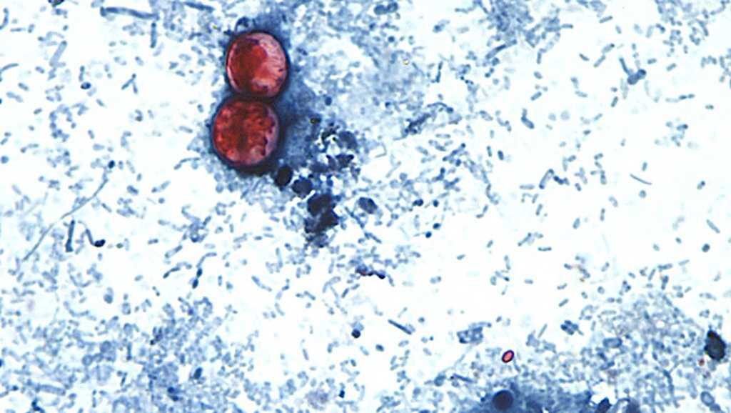 Cyclospora in Maryland: Cases more than double since last week - WBAL-TV