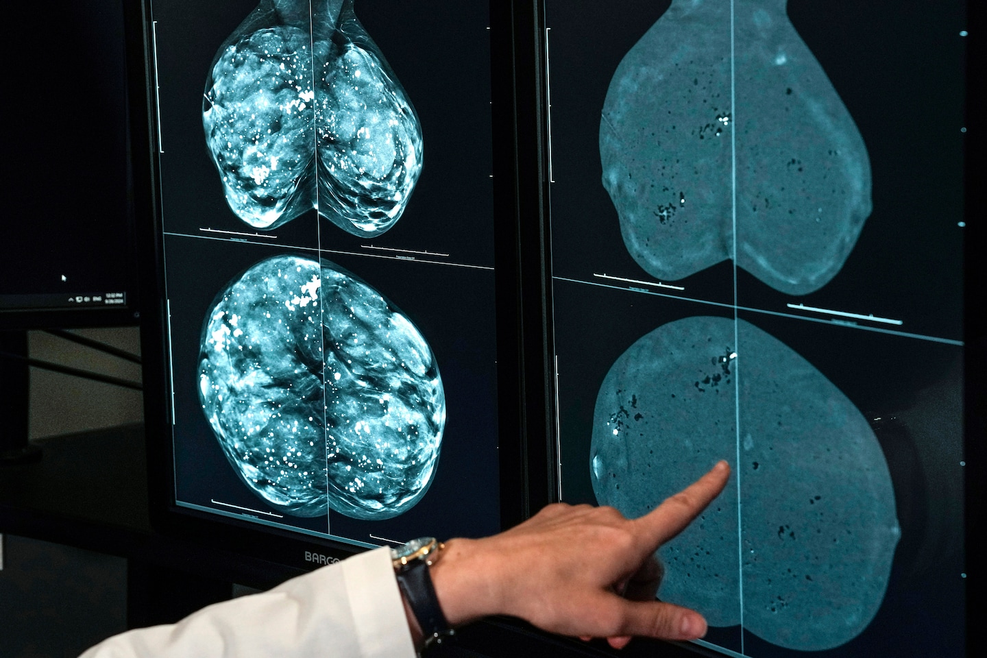 Cancer cases worldwide are expected to soar in the coming decades, a report finds. Here’s why. - The Washington Post