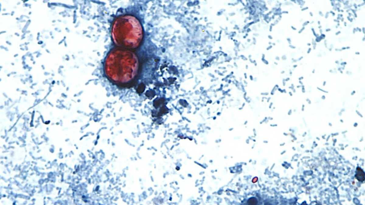 Norton warns parasitic infection causing 'explosive' diarrhea is on the rise in Kentucky - WLKY