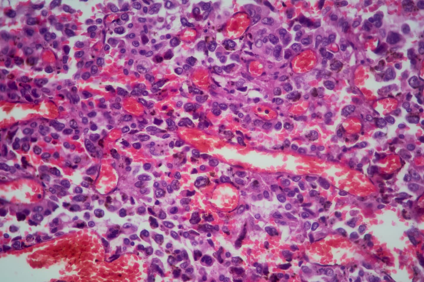 The screenings and other habits doctors recommend as early-onset cancers rise - The Washington Post