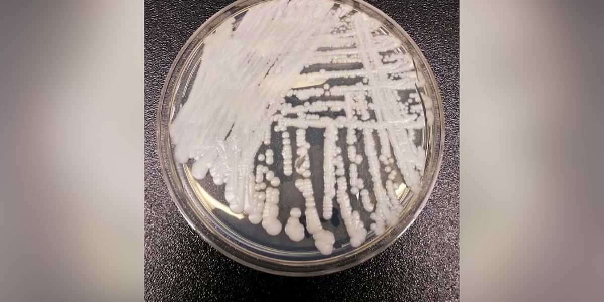 Arizona sees surge in ‘Superbug’ fungus cases, CDC data shows - AZ Family