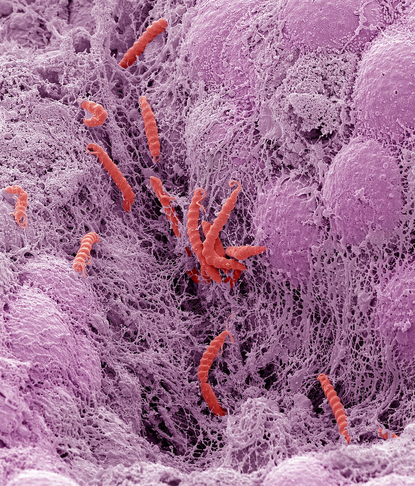 These common infections can cause cancer. Here’s what can lower your risk. - The Washington Post