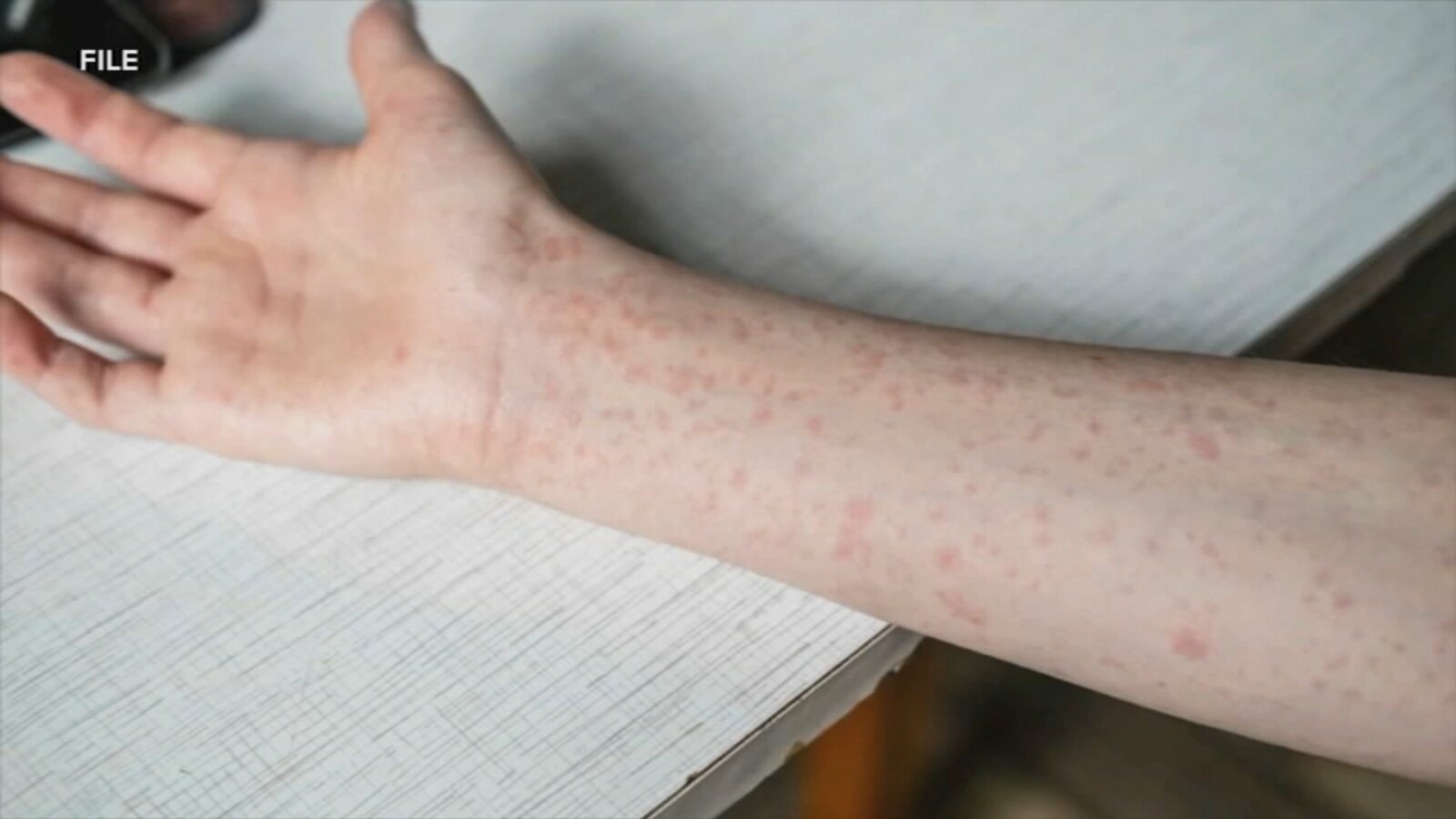 Oxford Area High School closed Friday after confirmed case of measles - 6abc Philadelphia